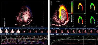 Comparative analysis of instantaneous wave-free ratio and quantitative real-time myocardial contrast echocardiography for the assessment of myocardial perfusion